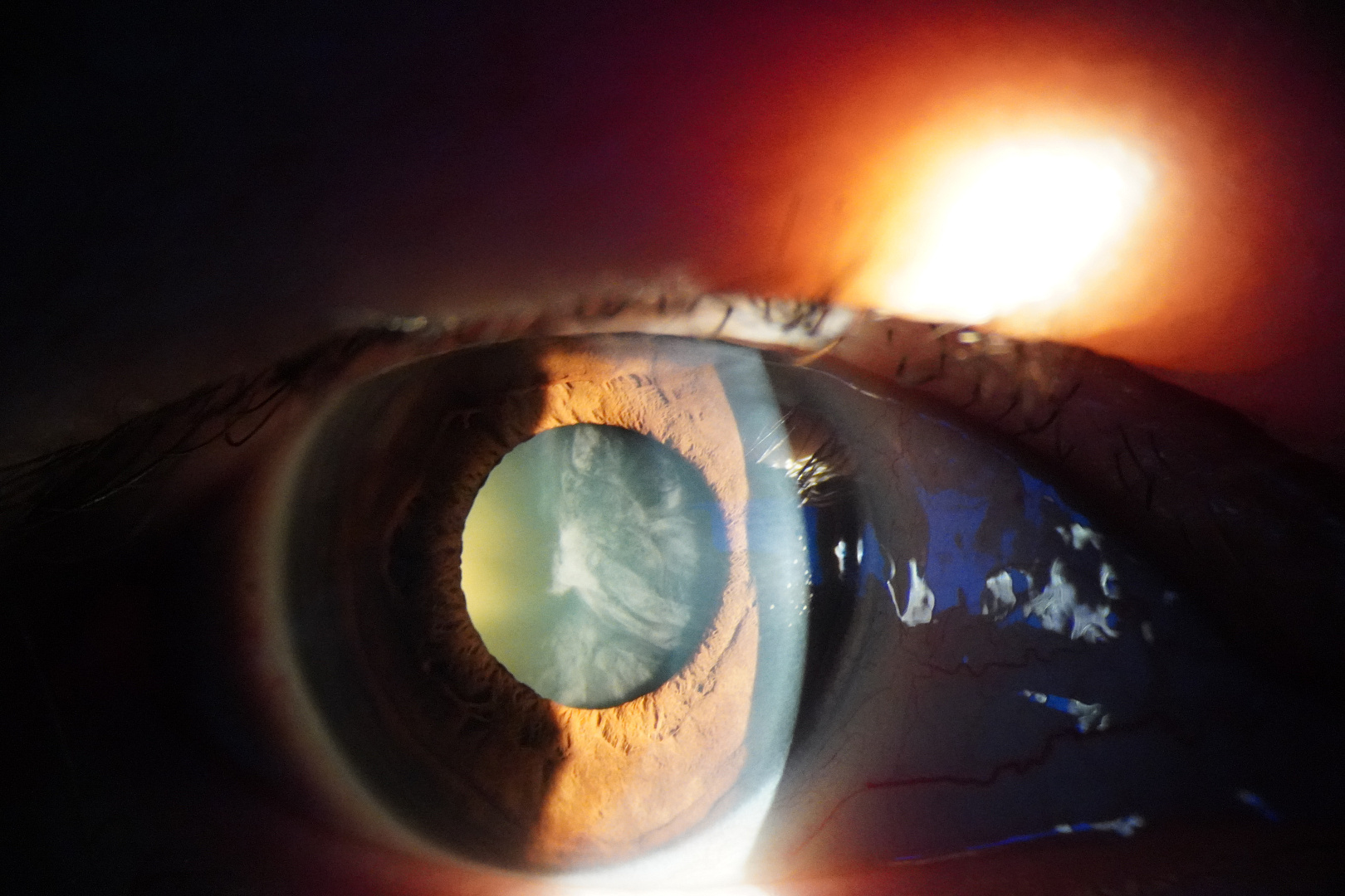 Главное о катаракте: симптомы и способы лечения