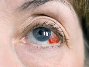 Субконъюнктивальное кровоизлияние,как причина красноты глаз