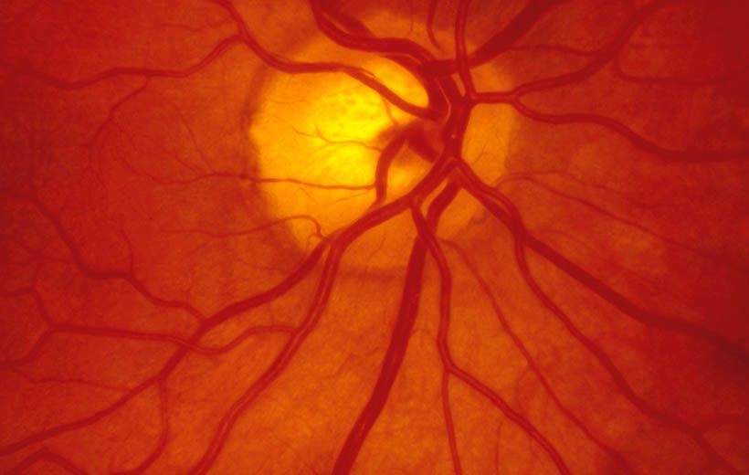 Атрофия зрительного нерва: причины, симптомы