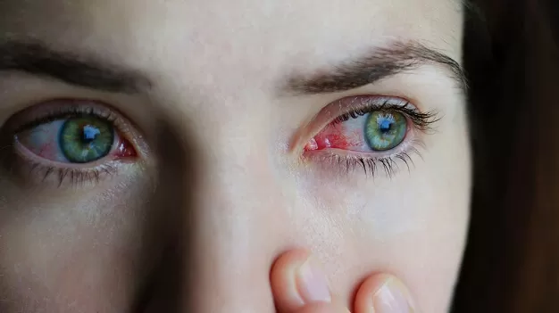 Почему у человека красные глаза: основные причины и методы лечения